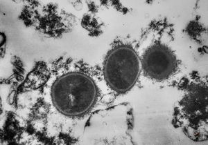 M,57y. | necrotizing pneumonia … unidentified microbes M,57y. | necrotizing pneumonia … unidentified microbes